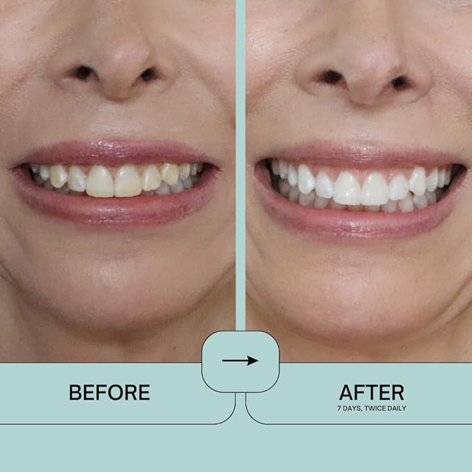 IntelliWHiTE ProStrips Teeth Whitening Strips Whitens Up to 12 Shades Enamel-Safe Gentle Remineralizing Formula Dentist Formulated for Sensitive Teeth (28pk Mint Flavor)