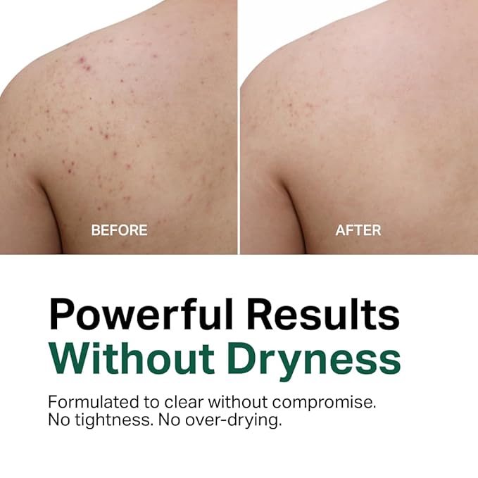 Y'OUR Aloe Vera Anti-Acne Body Wash | Gentle &amp Non-Drying Formula | Smooths Texture &amp Evens Tone | Clears Bacne &amp Breakouts for Women + Men Paraben &amp Sulfate Free Easy Gifts Idea