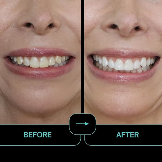 IntelliWHiTE ProStrips Teeth Whitening Strips Whitens Up to 12 Shades Enamel-Safe Gentle Remineralizing Formula Dentist Formulated for Sensitive Teeth (28pk Vanilla Flavor)