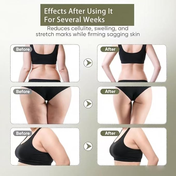 Lymphatic Drainage Massager &amp Anti Cellulite Massage Tool Helps Reduce Stretch Marks &amp Cellulite for Legs Arms &amp Belly Body Sculpting Machine with Microcurrent Light Heat &amp Vibra