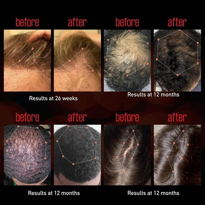 REVIAN Lyte Cap Hair Growth Device LED Wireless FDA Cleared Red Light Therapy Hair Loss Treatment for Men + Women Thinning Regrowth &amp Alopecia