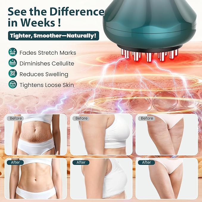 Lymphatic Drainage Massager Anti-Cellulite Massager For Body Cellulite and Thigh &amp Belly Stretch Marks Reduction Handheld Massage tools for lymphedema &amp lipedema Sciatica Nerve pain relief