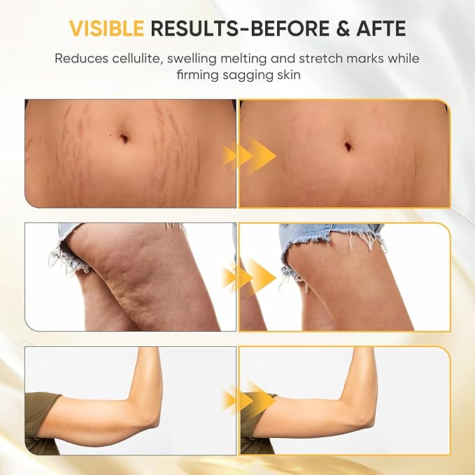 Lymphatic Drainage Massager - Anti Cellulite Massage Tool &amp Body Sculpting Machine with 30-Level Microcurrent Light Heat &amp Vibration for Legs Arms &amp Belly Body Helps Reduce Stretch Marks