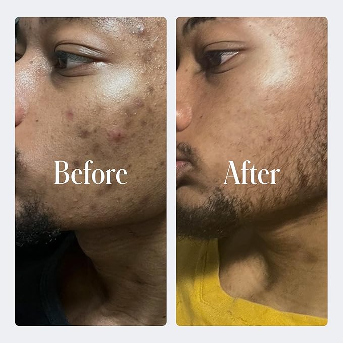 Geologie Complete Skincare Set for Men &amp Women | 3-Month Simple &amp Effective Daily Clear Skin Routine | Acne Oily Skin Dark Spots | Face Wash 2-Pack Retinol Face Cream SPF15 Moisturizer &am