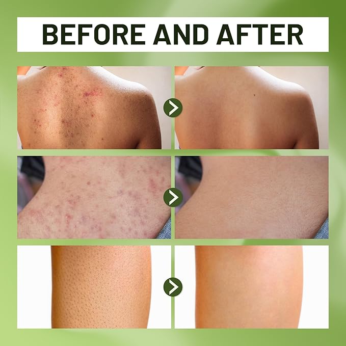 ABERA Folliculitis Shower Gel for Men &amp Women High-Performance Body Wash with BHA Wild Bitter Melon &amp Tea Tree Oil Reduce Back Acne &amp Hyperkeratosis Safe for All Skin Types 1014 Fl O