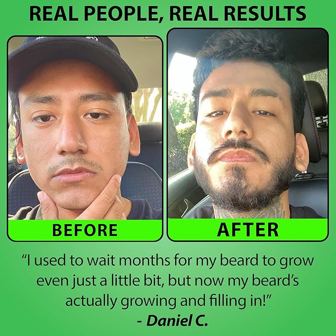 Minoxidil for Beard Growth – 5% Serum with 2X Biotin &amp Rice Water Promotes Thicker Fuller Facial Hair Ideal for Patchy Areas Revitalizes Follicles (Pack of 2)