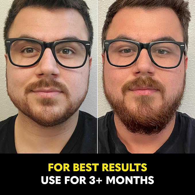 Beard Club - Beard Growth Serum with Natural Castor Coconut and Avocado to Grow a Thicker Fuller Beard Fill in Patches and Stimulate Healthier Facial Hair Growth