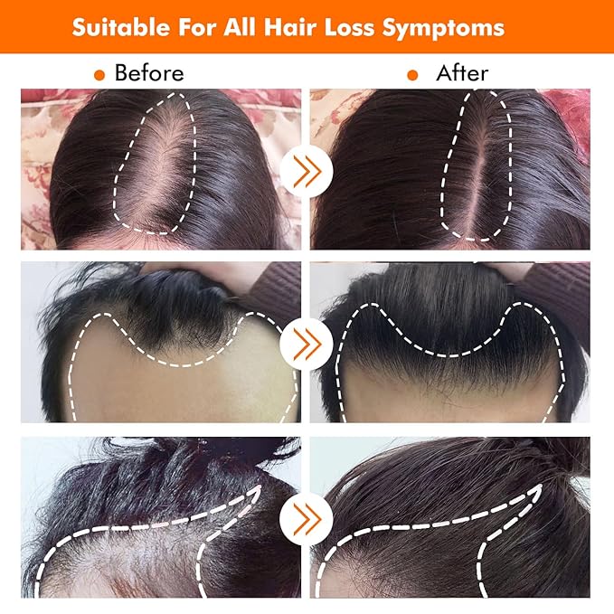 Hair Growth Kit Biotin Hair Growth Oil Serum Hair Scalp Massager Helps absorb Hair Growth Oil Serum
