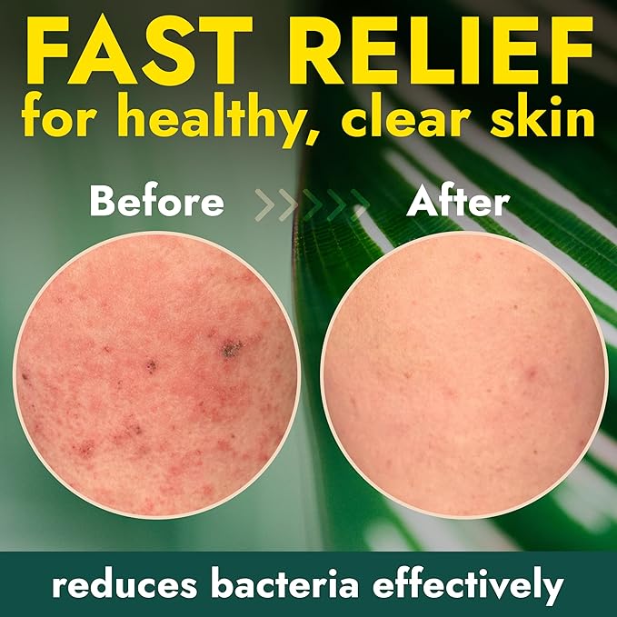 Antibacterial Body Wash with Tea Tree Oil | Antibacterial Soap for Men &amp Women | Kills 99.9% of Germs &amp Bacteria | Helps with Back Acne Body Odor &amp Skin Irritation | Includes Scrubber 16
