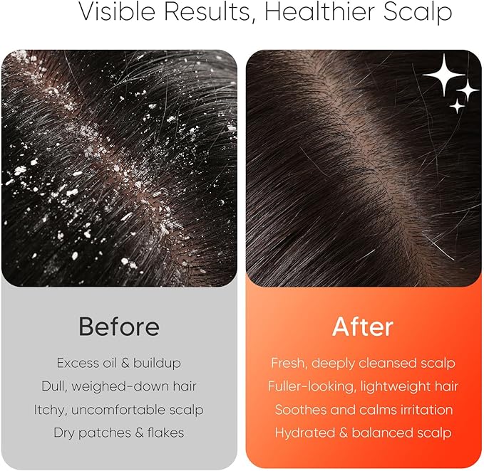 EKZ Sonic Vibrating Scalp Massager Shampoo Brush: Electric Silicone Hair Scrubber for Deep Scalp Clean Dandruff Removal Exfoliation Stress Relief &amp Hair Growth –Suitable for Women Men Kids &a
