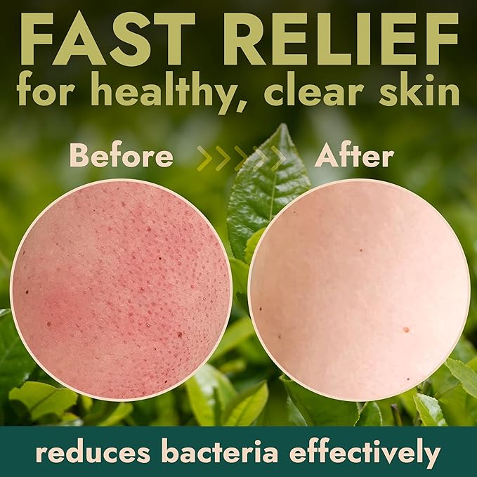 Antibacterial Body Scrub | Manuka Honey &amp Charcoal | Kills 99.9% of Germs &amp Bacteria | Body Scrub Exfoliator Deep Cleansing &amp Purifying for Smooth Fresh &amp Soft Skin | 16 fl oz
