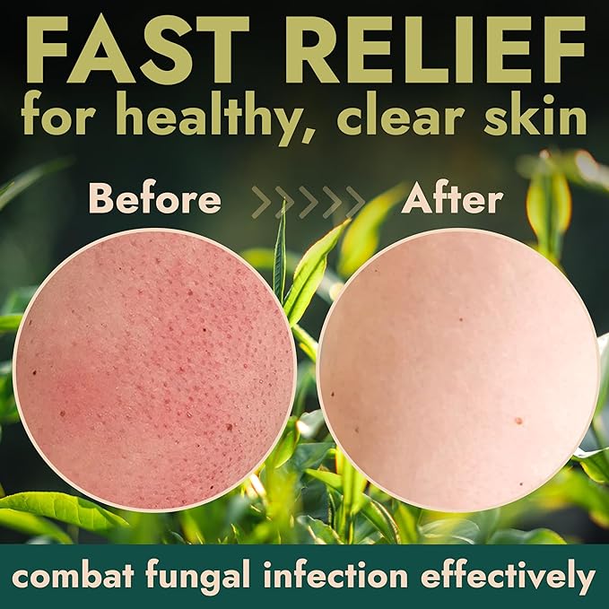 Terramed Just Think Comfort Antifungal Body Scrub with Tea Tree Oil – Exfoliating Body Wash for Women &amp Men – Soothes Itchy Skin Rashes Acne Warts &amp Insects Bites – 12 Fl oz with Scrubber B