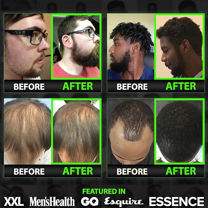 Beard Growth Serum - GROW Maximum XXL Beard Growth Oil for Men -Thickens &amp Fills Patches - Facial Hair &amp Scalp Treatment - Beard &amp Hair Thickening Conditioner &amp Enhancer