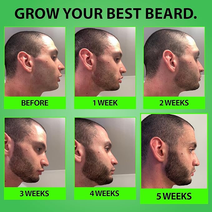 Minoxidil for Beard Growth – 5% Serum with 2X Biotin &amp Rice Water Promotes Thicker Fuller Facial Hair Ideal for Patchy Areas Revitalizes Follicles (Pack of 2)